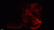 Human Amyloid Buildup