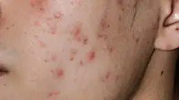 Acne on Face