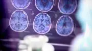 Alzheimers Protein Brain Scans