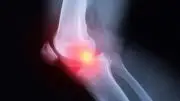 Arthritis Knee Pain X-ray Illustration
