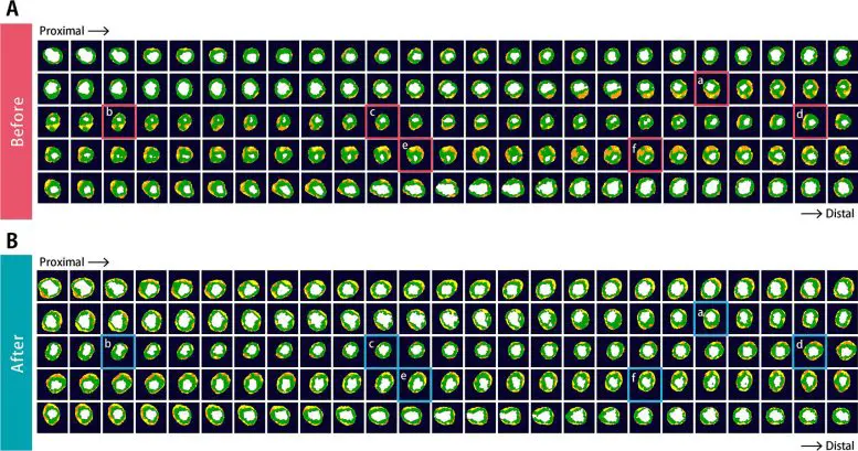 Coronary CT Images With a Color Coded Display