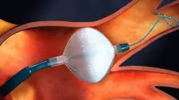 Cryoballoon Ablation