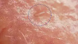 Demodex folliculorum Mite on Skin