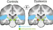 discovered an important neural mechanism underlying dyslexia