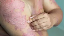 Eczema Dermatitis Skin