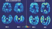 From mild cognitive impairment to Alzeimer's disease