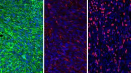 Glioma Cells