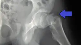 Hip Fracture Concept