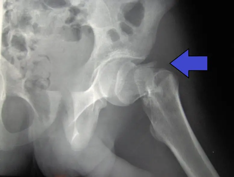 Hip Fracture Concept