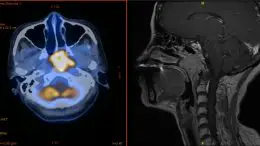 Nasopharyngeal Tumors