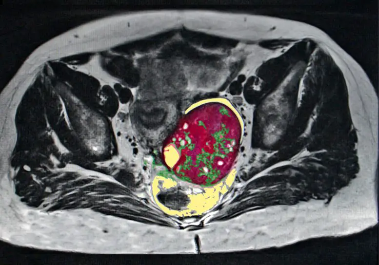 Ovarian Cancer MRI