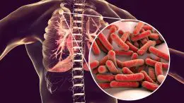 Secondary Tuberculosis Infection Anatomy Image