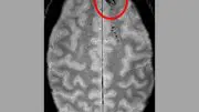 Traumatic Microbleeds in the Brain