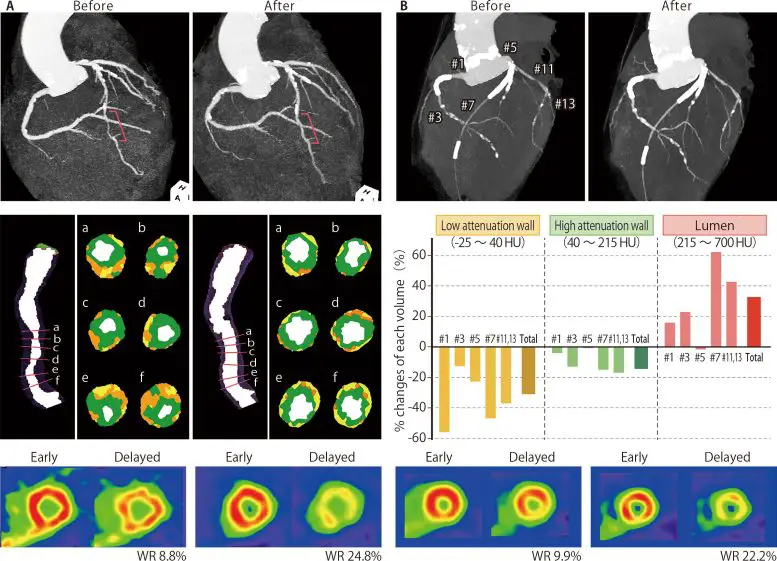 Triglyceride Deposit Cardiomyovasculopathy