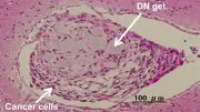 Tumor Formation in Mouse Brain