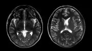 Two Brain Scans