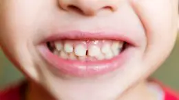 Young Child Teeth